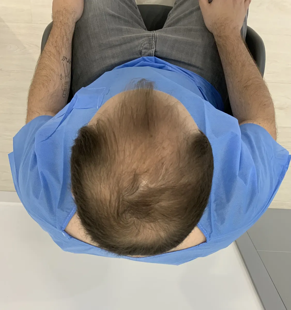 Vista superior del pelo para valoración capilar, imagen 1