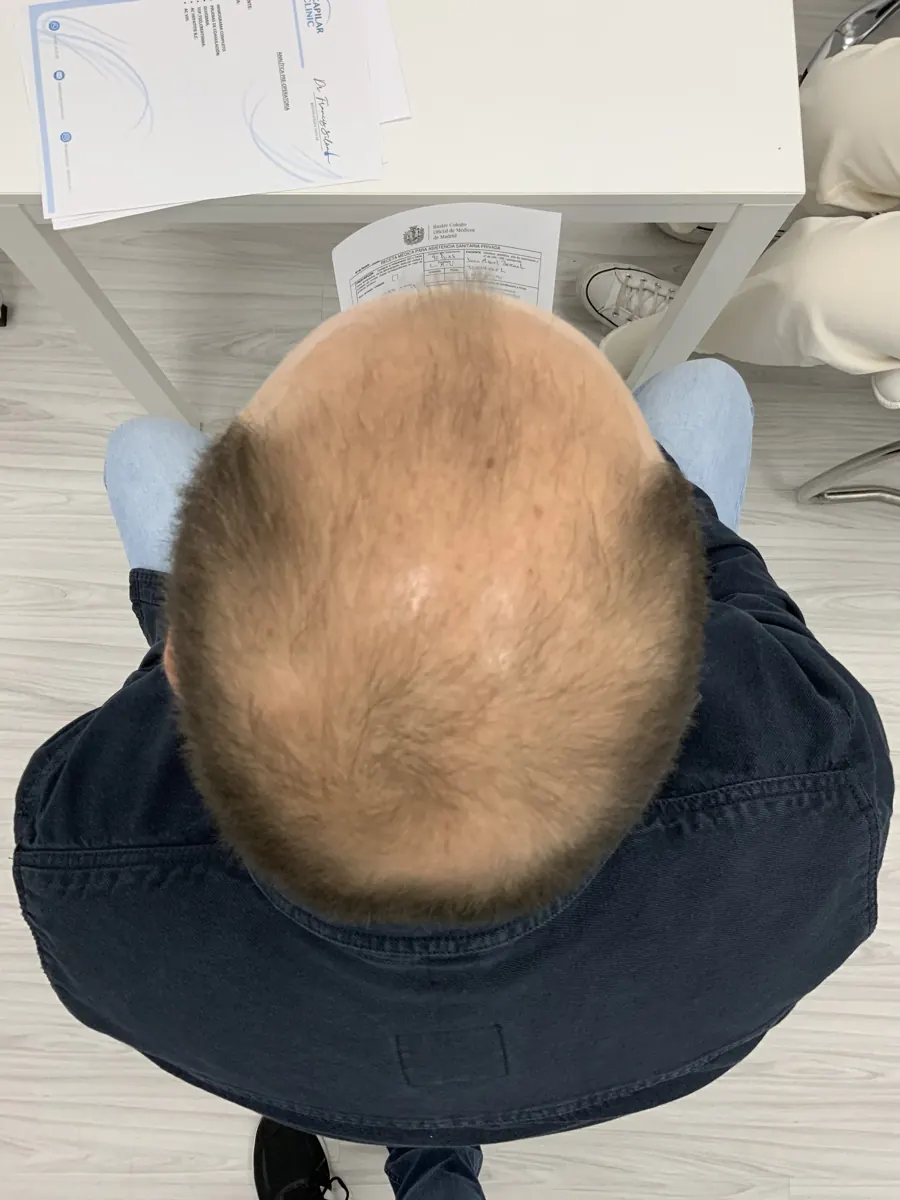 Vista superior del pelo para valoración capilar, imagen 2