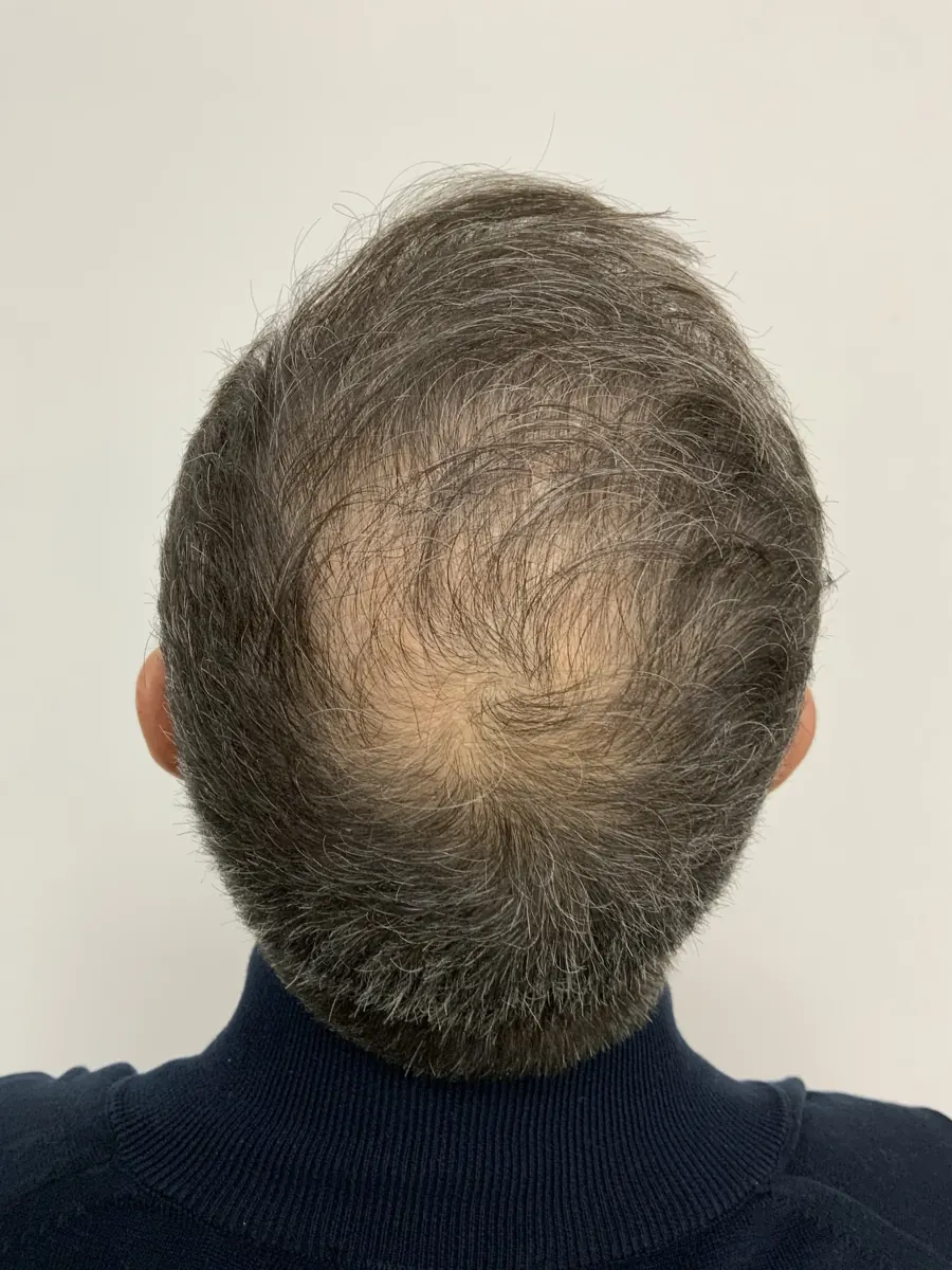 Vista superior del pelo para valoración capilar, imagen 3